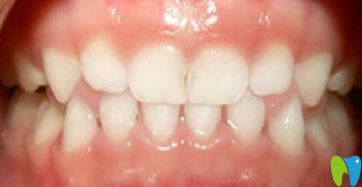 歡樂(lè)口腔乳牙反頜矯正效果