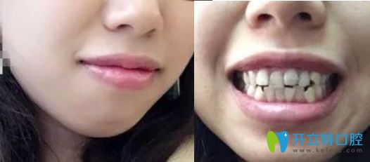 沒在深圳汪洋齒科口腔做牙齒矯正前照片 沒在深圳汪洋齒科口腔做牙齒矯正前照片