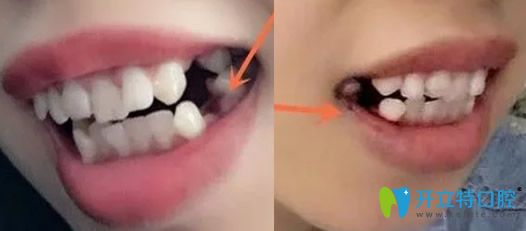 深圳汪洋齒科牙齒矯正拔4顆牙后的照片 深圳汪洋齒科牙齒矯正拔4顆牙后的照片
