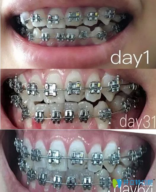 汪洋齒科牙齒矯正圖片對照圖 汪洋齒科牙齒矯正圖片對照圖