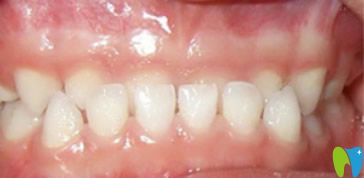 深圳歡樂(lè)口腔乳牙反頜矯正前