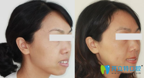 蒙恩齒科程碧煥隱形牙齒矯正前后效果對比圖