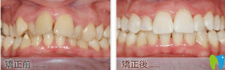 長沙雅美口腔牙齒矯正前后效果對比圖 長沙雅美口腔牙齒矯正前后效果對比圖
