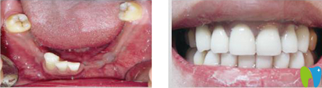 長沙雅美口腔種植牙前后效果對比圖 長沙雅美口腔種植牙前后效果對比圖