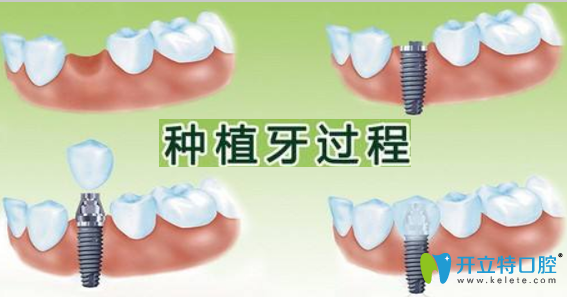 廣州廣大口腔牙齒種植醫(yī)生來簡述種植牙的利與弊有哪些