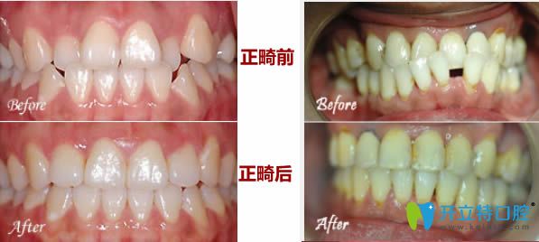 26歲輕微牙齒不齊矯正和28歲反頜且牙齒間隙正畸前后對(duì)比照