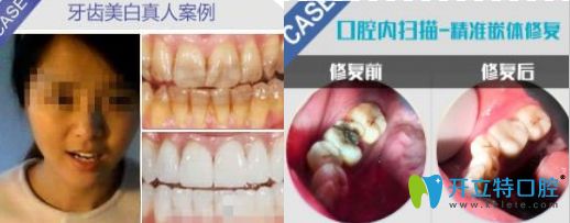 佛山粵冠牙科牙齒美白及修復(fù)圖