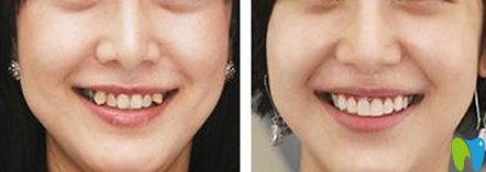 清遠(yuǎn)中大口腔牙齒矯正前后效果對(duì)比圖