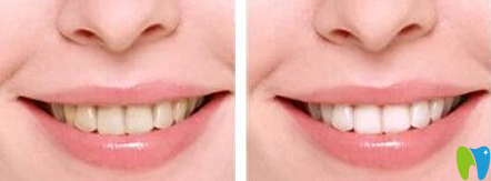 中大口腔冷光美白牙齒前后效果對(duì)比圖