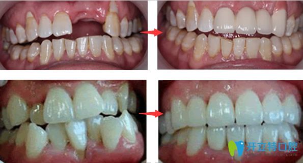 韋博口腔種植牙+牙齒矯正效果案例 韋博口腔種植牙+牙齒矯正效果案例