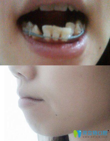 蘇州美奧口腔牙齒正畸過程中