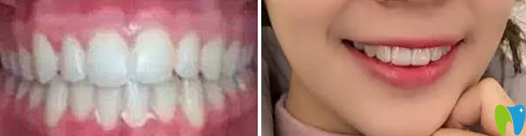 中山香山口腔譚智堅(jiān)院長(zhǎng)給我做隱形牙齒矯正一年的效果