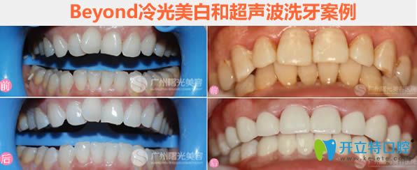 Beyond冷光美白和超聲波洗牙前后對(duì)比圖