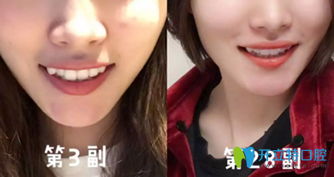 我在廣州德倫口腔做隱適美牙齒矯正過(guò)程中 我在廣州德倫口腔做隱適美牙齒矯正過(guò)程中