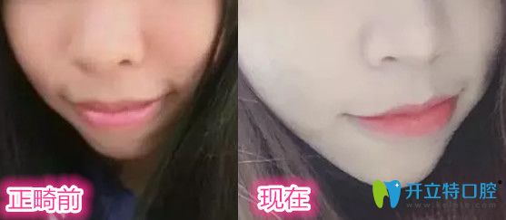 讓<!--<i data=20240703-sp></i>-->口腔醫(yī)生做牙齒正畸前后對(duì)比照片一覽