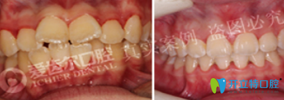 武漢愛齒爾口腔好不好？來看牙齒矯正案例