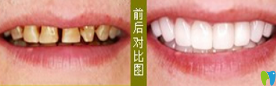 在武漢愛齒爾口腔做牙齒修復(fù)治療前后對(duì)比圖