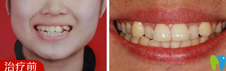 佛山愛頓口腔靠譜嗎？隱形牙齒矯正6個月的效果圖來見證