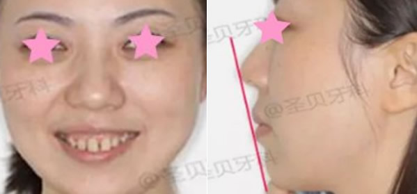 成都圣貝口腔笑起來露牙齦怎么矯正 成都圣貝口腔牙齒矯正案例教您方法