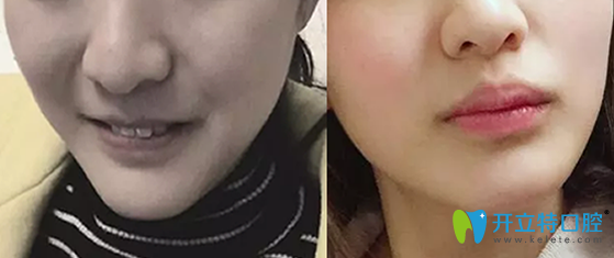 北京康貝佳口腔牙齒矯正前后對(duì)比圖