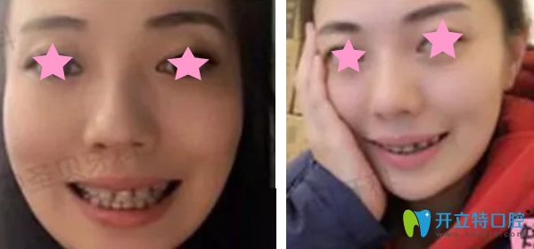 陶瓷半透明隱形矯正帶牙套 陶瓷半透明隱形矯正帶牙套