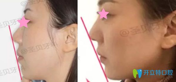 成都圣貝齒科矯正牙齒一年后效果 成都圣貝齒科矯正牙齒一年后效果