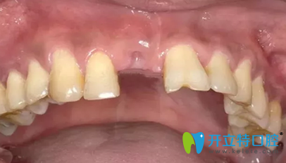 北京嘉和口腔即刻種植牙拔牙后照片