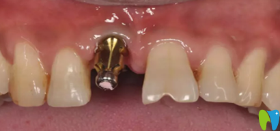 嘉和口腔即刻種植牙過程圖