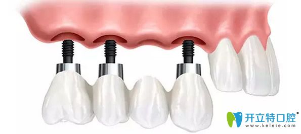 種植牙壽命與周圍鄰牙有很大關(guān)系