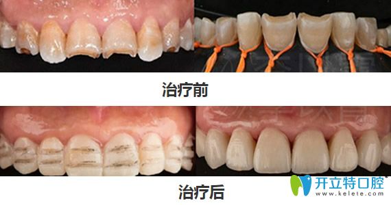 弘和齒科李以霄超薄仿生瓷貼面牙齒修復案例