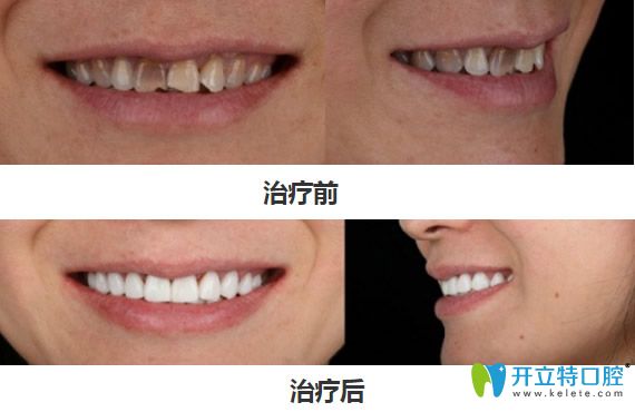 深圳弘和口腔四環(huán)素貼面修復案例對比圖