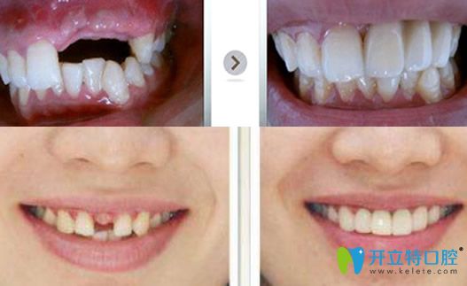 舒斯特牙齒種植案例前后對(duì)比照片