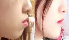 北京佳美口腔北京佳美口腔牙齒矯正560天來曬照 大家覺得正畸后變化大嗎