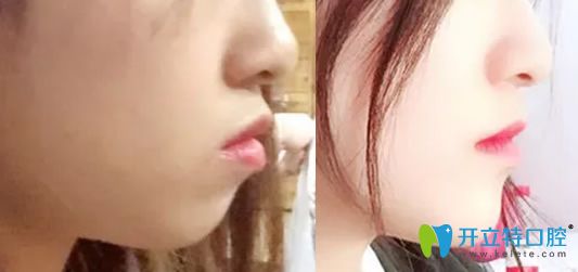 牙齒矯正能改變臉行嗎？看佳美口腔牙齒矯正前后對比照片知