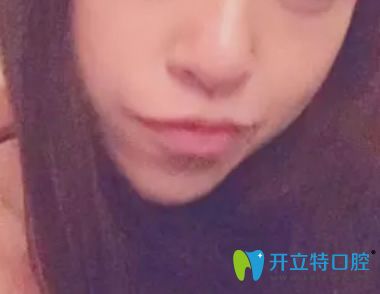 北京佳美口腔剛開始矯正戴牙套的樣子