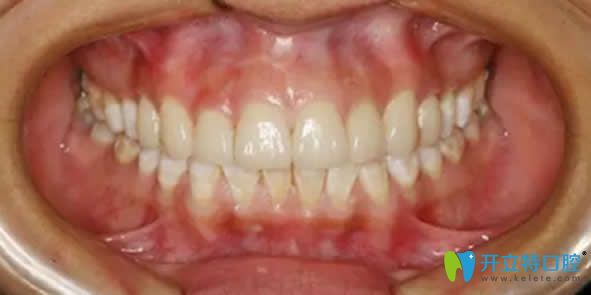 佛山華美口腔全瓷貼面修復(fù)效果