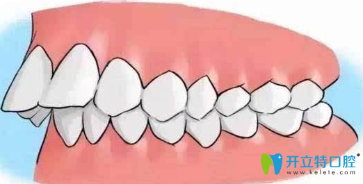 修復(fù)齙牙多少錢？齙牙矯正方法及價(jià)格表分享