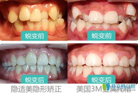 西安牙齒矯正哪家好？看西安雁塔惟真口腔隱適美矯正+金屬托槽矯正案例