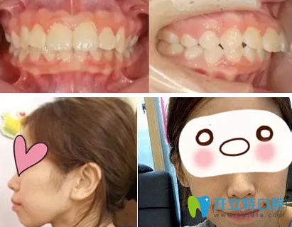 上?？泼揽谇辉趺礃?？看了我28歲牙齒矯正前后照片真是后悔
