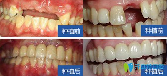 西安雁塔惟真口腔怎么樣？百萬真實(shí)案例，彰顯種植優(yōu)勢(shì)