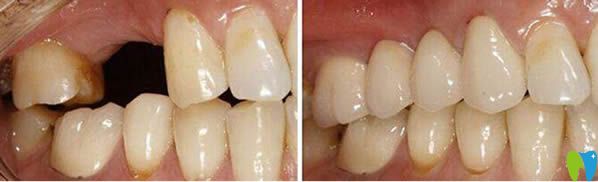 北京美年口腔黃俊淋主任單顆牙缺失種植牙前后對比效果