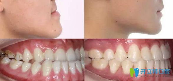 維樂口腔牙齒矯正前后效果對(duì)比