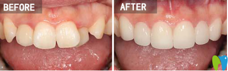 楊國平醫(yī)生數(shù)字化DAMON快速矯正案例