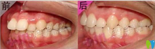 長沙雅美28歲顧客牙齒矯正前后對比照