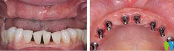 重慶維樂口腔半口牙缺失種植前