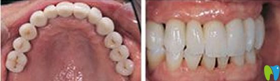 維樂口腔即刻種植牙術(shù)后效果