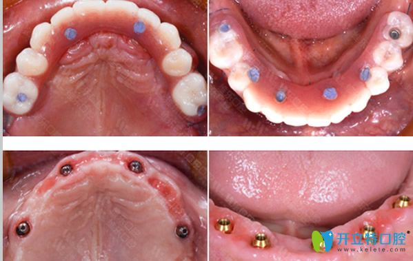 牙齒種植前設(shè)計種植方案