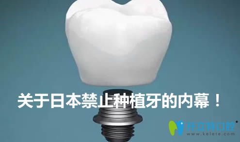 內(nèi)幕！日本為什么停止種植牙？禁止種植牙是真的嗎？