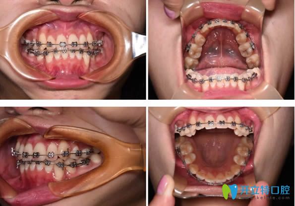 佩戴自鎖金屬托槽矯正器一年后的矯正效果