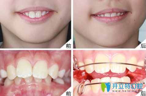 樸雄希兒童門(mén)牙前突矯正案例